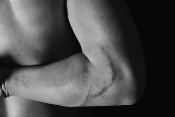 alex nault post oporation scar on elbow photograph